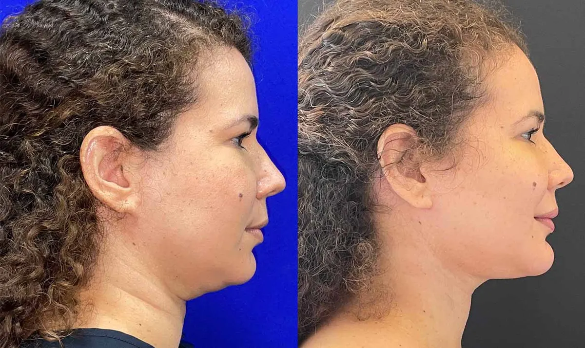 Antes e depois de contorno cervical – paciente do Dr. Adriano Borges em Brasília