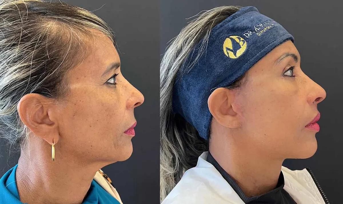 Antes e depois de deep plane facelift – paciente do Dr. Adriano Borges em Brasília
