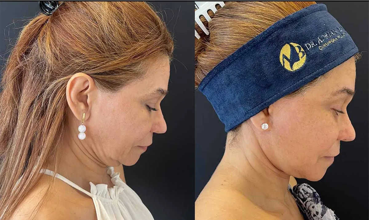 Antes e depois de rejuvenescimento facial – paciente do Dr. Adriano Borges em Brasília