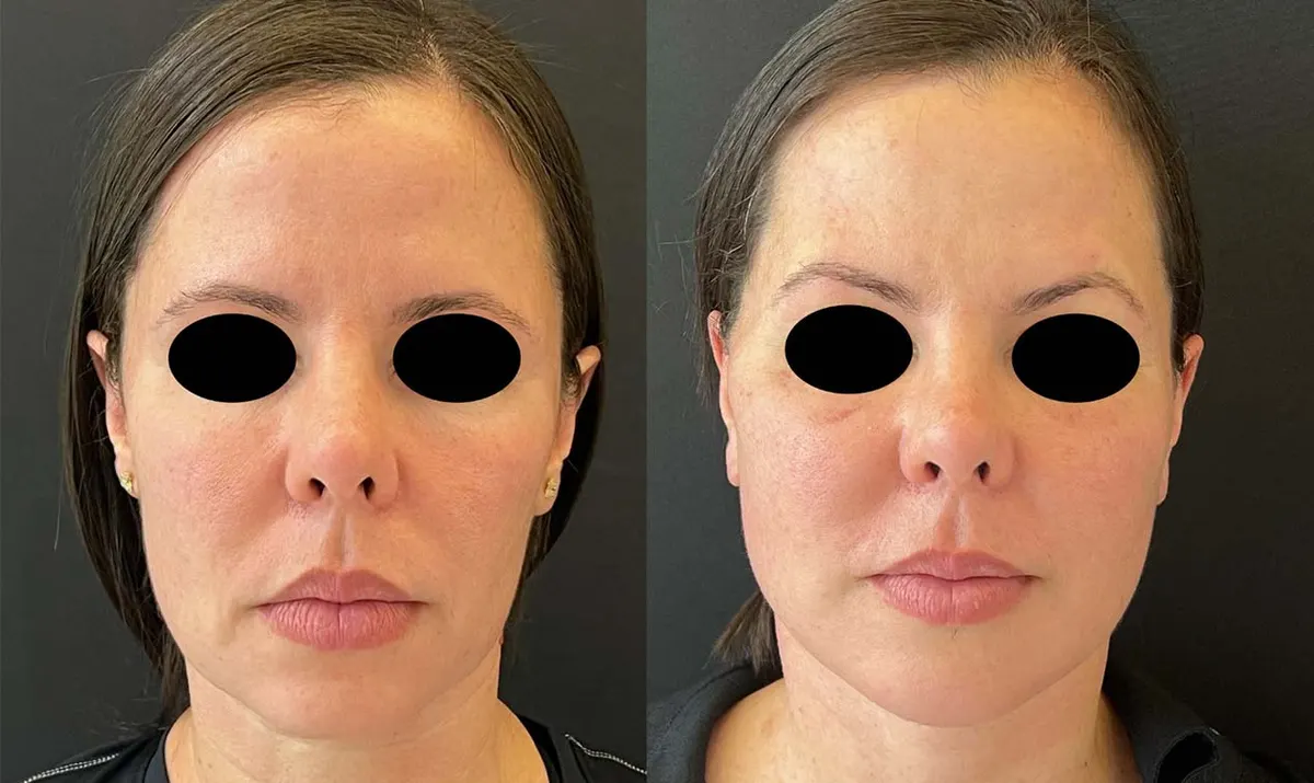 Antes e depois de rejuvenescimento facial – paciente do Dr. Adriano Borges em Brasília