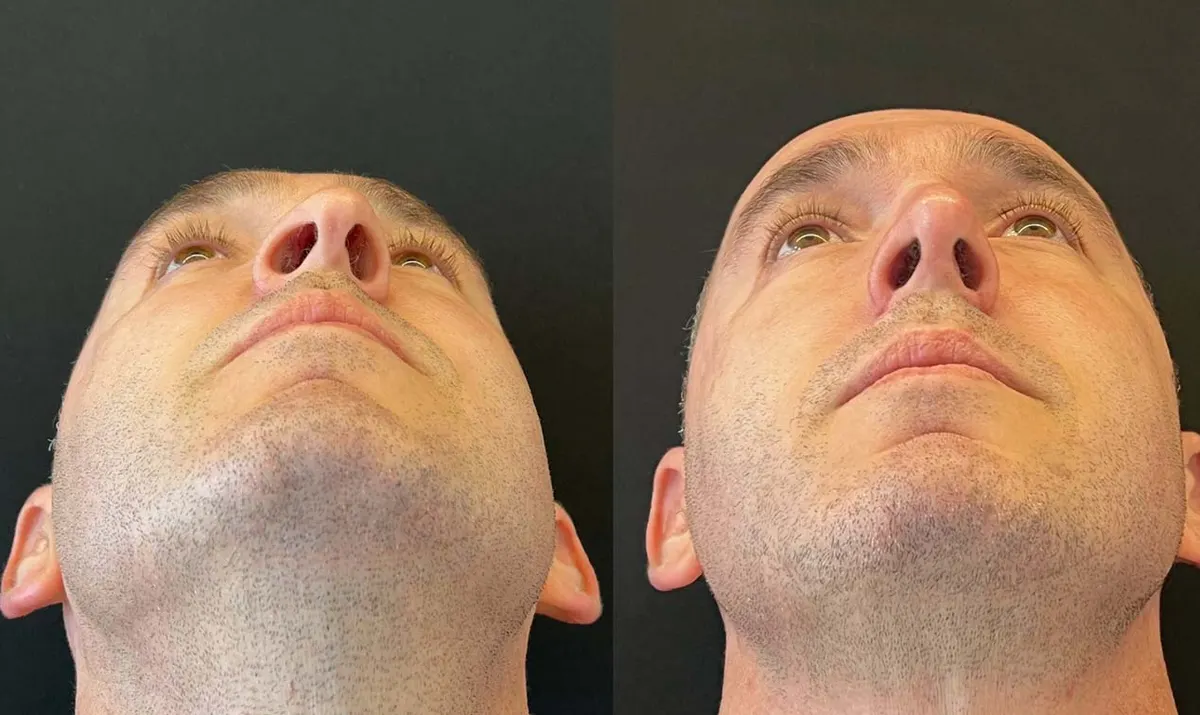 Antes e depois de rinoplastia – paciente do Dr. Adriano Borges em Brasília