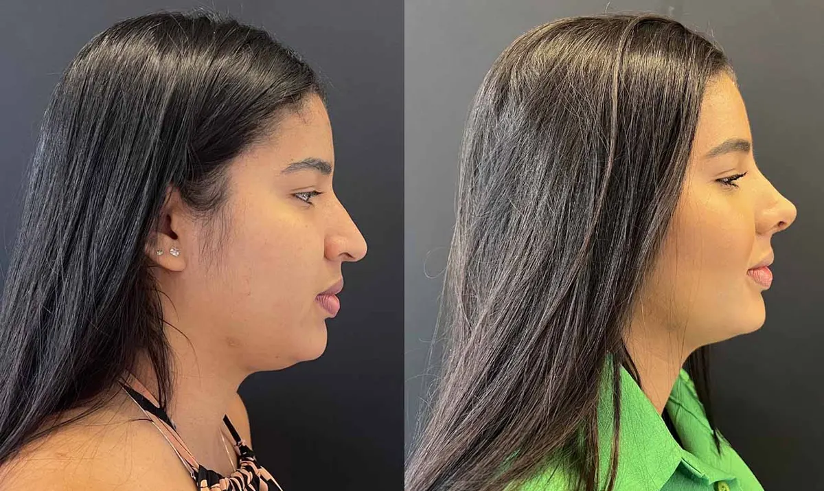 Antes e depois de rinoplastia – paciente do Dr. Adriano Borges em Brasília