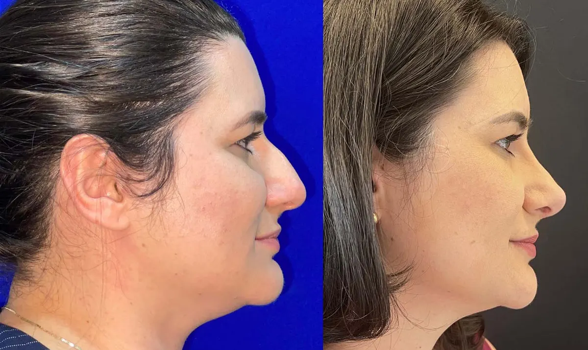 Antes e depois de rinoplastia – paciente do Dr. Adriano Borges em Brasília