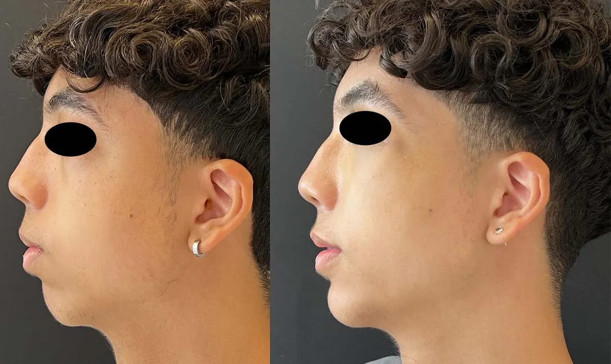 Antes e depois de rinoplastia – paciente do Dr. Adriano Borges em Brasília